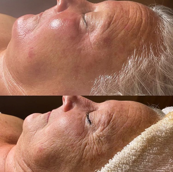 PRX- 33 Bio Estimulator Peel