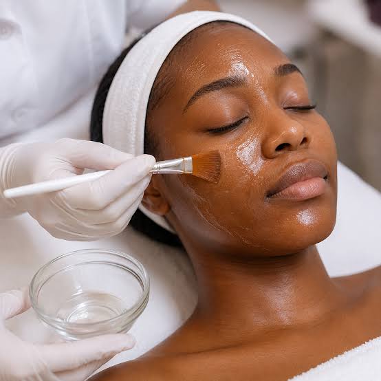 Chemical Peels